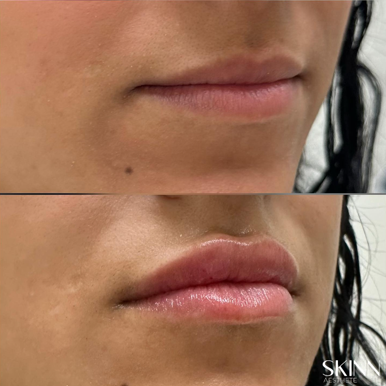 Before and after lip treatment results.
